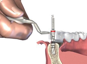 Krok 4 Rozšiřte lůžka implantátu na Ø 3,5 mm Pokračujte se základní preparací lůžka implantátu použitím spirálního vrtáku PRO určeného pro navigovanou chirurgii o Ø 3,5 mm.