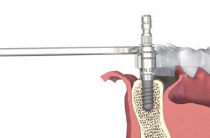 Nasaďte adaptér násadce na implantát.