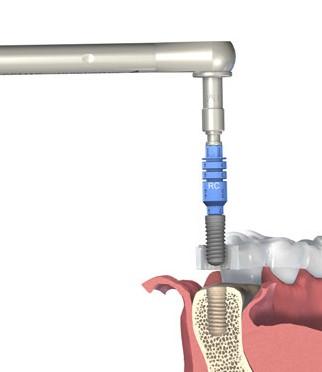 3 3 Krok 3 Vyjměte implantát z ampule Stáhněte vnitřní ampuli směrem dolů a ve stejnou dobu