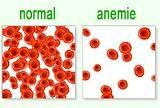 Onemocnění červené řady Anemie -obecně málo erytrocytů nebo hemoglobinu Příčiny: nedostatečná