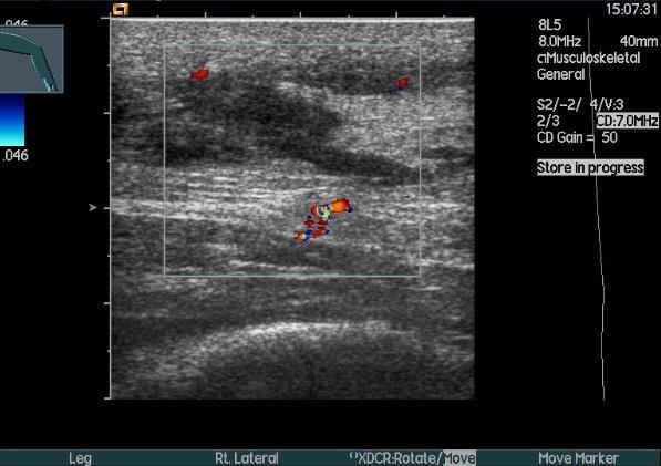 Traumatologie v muskuloskeletální oblasti Ruptura tendo Achilles Nejčastěji vyšetřované oblasti Manžeta rotátorů (ruptura šlach m. supraspinatus, m. subscapularis, m.