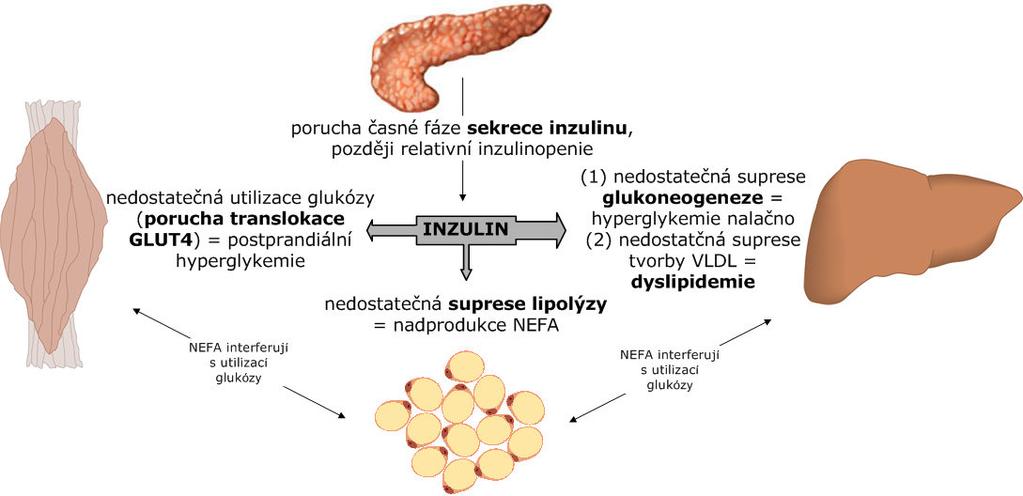 Patogeneze rozvinutého T2DM 37 Další typy DM LADA (Latent Autoimmune Diabetes in Adults ) = slow-onset T1DM diagnóza > 30 let věku, zpravidla mylně jako T2DM zpočátku dobře kontrolovatelný dietou a