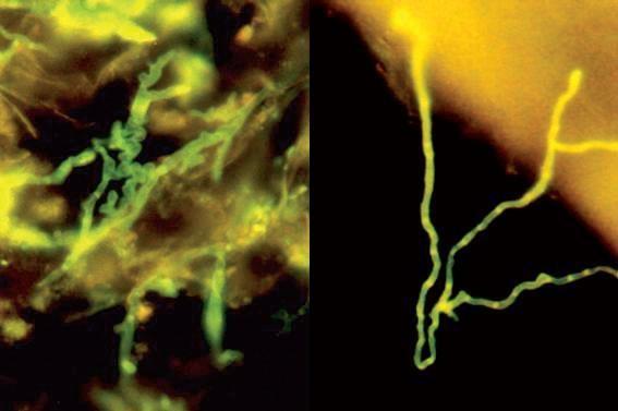 Obr. 16 Hyfy při fluorescenčním vyšetření pomocí Rylux BSU v KOH [47] 3.3 Histologické vyšetření Vizualizace mykotických elementů ve tkáních je základním kamenem diagnostiky invazivních mykóz.