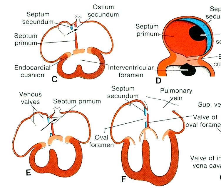 septum interventrikulární roste od hrotu směrem k endokardovým návalkům, pars membranacea septi se utváří jako poslední současně s