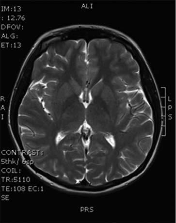 Charakteristickými projevy jsou diabetes mellitus, mikrocytární anémie, degenerace sítnice a z neurologických projevů orofaciální dystonie, chorea, třes, parkinsonizmus, ataxie a kognitivní deficit.