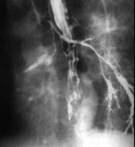 Neakutní indikace k odložené torakotomii u tupého poranění hrudníku Chylotorax Přehlédnuté tracheobronchiální