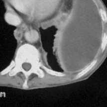 Neakutní indikace k odložené torakotomii u tupého poranění hrudníku Neevakuovaný opouzdřený hemotorax