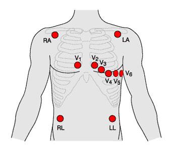 2 Způsob měření EKG Elektrická aktivita srdce se měří na povrchu těla pomocí elektrod vhodným způsobem rozmístěných na kůži.