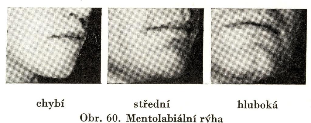 pod linií úst Bradová rýha (mentolabiální): 1.