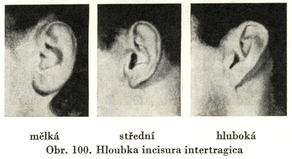 Hloubka incisura intertragica: 1. mělká, 2. střední, 3.