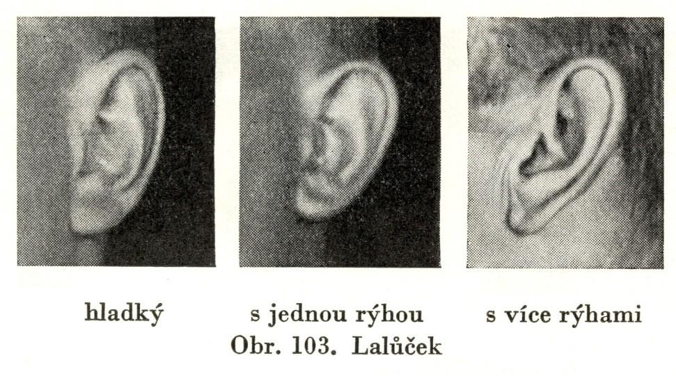 Rýhy a vrásky na lalůčku: 1. lalůček je hladký, 2.