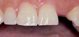 Výzkum Implantát v místě horního laterálního řezáku Autor: Dr. Philippe Russe & Dr. Patrick Limbour, Francie Obr. 1 Obr. 2 Obr. 1: Ageneze zubu 22, ortodontické otevírání mezery Obr.