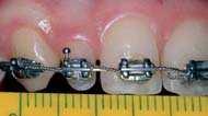 Výzkum Implantát v místě horního laterálního řezáku Obr. 9: Tremata vytvořená kolem čípkovitého zubu pro získání prostoru 6 mm Obr.