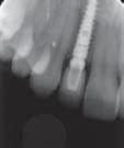 Implantát v místě horního laterálního řezáku Výzkum Obr. 11 Obr. 12 Obr. 13 Obr. 14 Obr. 11: Kostní štěp in situ vytvarován tak, aby sloužil jako podklad pro budoucí papily (případ prezentován na obr.