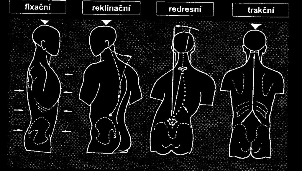 Obrázek 6: Biomechanický účinek trupových ortéz (Krawczyk,2002). 5.2.1 Dělení trupových ortéz Trupové ortézy dělíme podle materiálu a lokalizace skoliózy páteře, popřípadě jiné poruchy a onemocnění páteře.