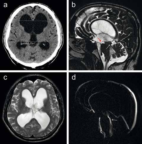 b postkontrastní T1 vážené MR zobrazení lépe zobrazuje vlastní tumor (krátké šipky) se solidní a cystickou složkou.