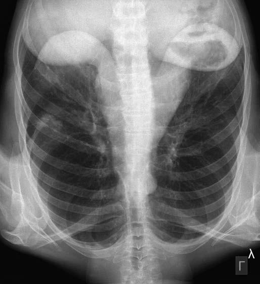 OSIMERTINIB V LÉČBĚ METASTATICKÉHO ADENOKARCINOMU PLIC S PROKÁZANOU ZÍSKANOU MUTACÍ T790M také kožní vyrážka III. stupně toxicity.