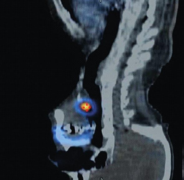 12,13 Kromě sublinguální, tyreoglosální a laryngotracheální ektopie jsou v oblasti hlavy a krku uváděny i další lokality ektopické tkáně štítné žlázy, ve většině ojedinělé případy podčelistní žláza,
