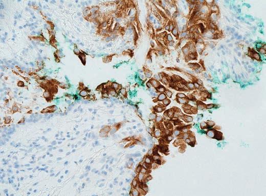 Diagnózu zhoubného novotvaru stanovili na lůžkovém oddělení pneumologie a ftizeologie v Českých Budějovicích, kam byla nemocná přijata původně s podezřením na bronchiální astma.