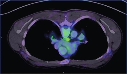 Druhé kontrolní vyšetření PET/CT ze 7. listopadu 2017 a MR mozku dne 13.