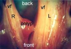 Nemoci z jiných faktorů a činitelů kapitola VI 1 případ 1x polyp