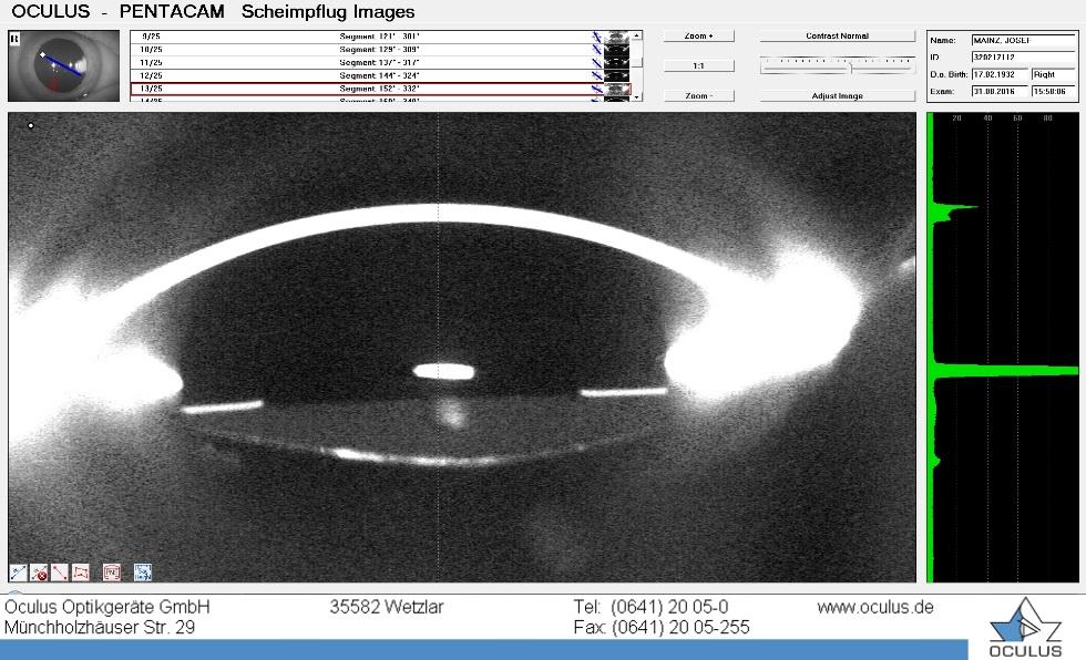 Například ve Švédsku bylo v roce 2009 provedeno 80 000 operací šedého zákalu. Přesnost výpočtu nitrooční čočky závisí na předoperačním biometrickém měření a zvolením vhodného výpočetního vzorce.