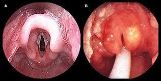 Akutní pablánová laryngotracheobronchitis Alergický otok v laryngu a suglotickém prostoru: