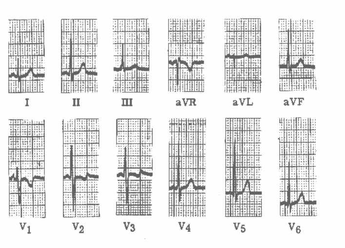 Amplitudová a frekvenční modulace ještě jednou Elektrokardiogram je typickým příkladem biosignálu, v němž je informace kódována frekvenčně (např.