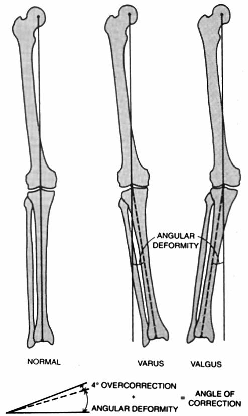 2.6 GENU VARUM Varozita kolenního kloubu může být buď vrozená, nebo získaná. Získaná varozita může být způsobena nerovnoměrným zatěžováním chodidel, který fungují jako tlumiče nárazů.