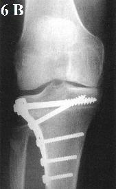 Podle Coventryho je nejlepších výsledků pro genu varum po proximální osteotomii tibie dosaženo, pokud je provedena korekce anatomické osy tibie na 8-10 do valgozity (mechanické je to pak 2-4 ).