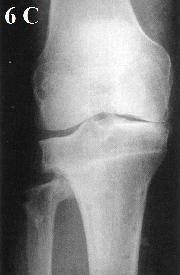 6 A-C korekční osteotomie tibie vnějším uzavřením (A před operací, B osteosyntéza po operaci, C zkorigované postavení po vyndání šroubů) (25) 2.