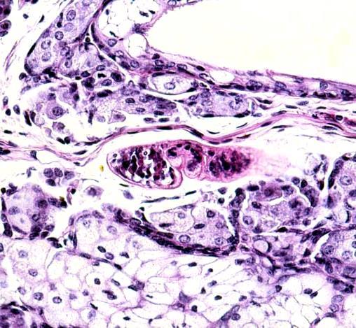 Schistosomóza: FÁZE INFEKCE cerkáriová dermatitis vznik vyrážky do 12-48 hodin po pobytu v rizikových vodách