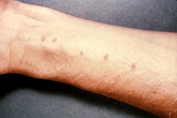 Cerkáriová dermatitida