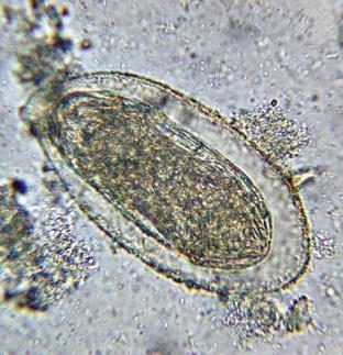 lymfatických uzlin 1 S. mansoni 2 S. japonicum 3 S. haematobium S.