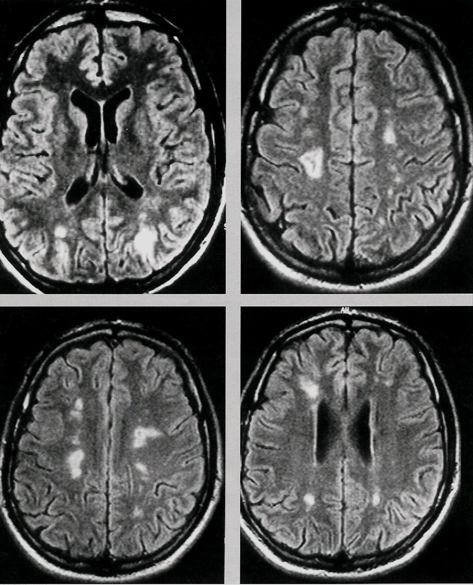 S. mansoni, S. japonicum, S. haematobium chronická infekce: CNS Granier et al.