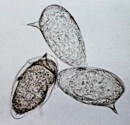 37-letá Holanďanka, nulipara, zhoršující se dysmenorhoea, menorrhagia palpační vyš., sono: cytologie cervixu: krevní obraz a hematokrit: hormonální vyš.