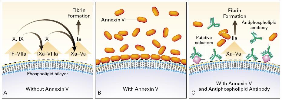 Obr.4 Mechanismy redukce hladin anexinu V a akcelerace koagulace asociovaná s antifosfolipidovými protilátkami (převzato z Rand, NEJM, 1997) 23 A negativně nabité fosfolipidy na povrchu dvojvrstevné