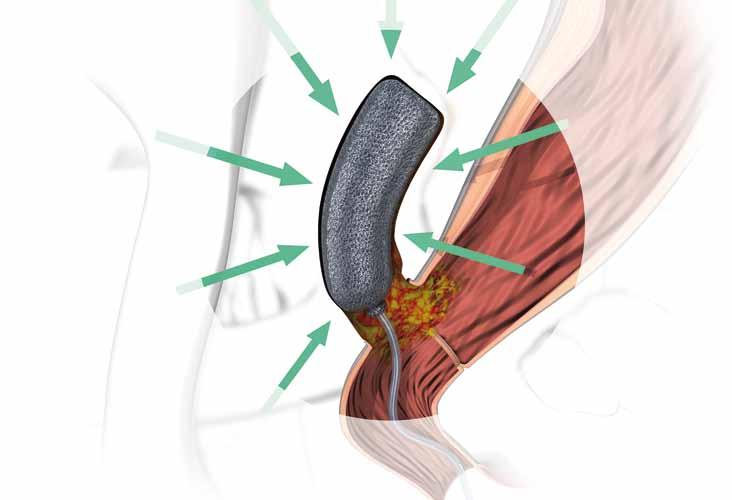 Léčba pomocí Endo-SPONGE Otevřené póry houbičky umožňují rovnoměrné přenesení sacího účinku na všechny tkáně, které jsou v kontaktu s povrchem houbičky.