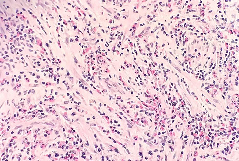 129 cytózu či epiteloidní hemangiom, které však při imunohistochemickém vyšetření nebyly potvrzeny.