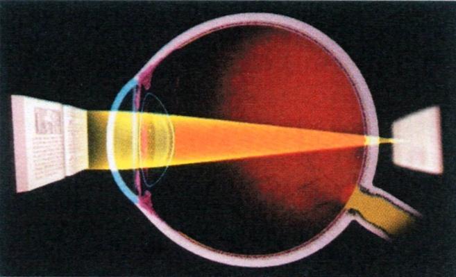 Obrázek 1 Při hypermetropii je oko vzhledem k optické mohutnosti oka relativně krátké (4) 3.1.1.1 Dělení hypermetropie latentní - překonává se vlastním napětím ciliárního svalu, zjistíme ji, jen kdyţ nakapeme atropin a bývá kolem 1 D.