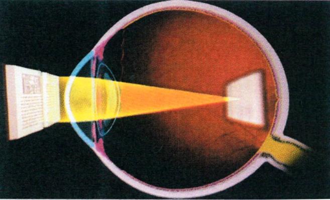 Obrázek 2 Zobrazení průchodu paprsků při hypermetropii s korekcí a bez korekce (3) 3.1.2 Myopie Myopie - krátkozrakost - příčinou je relativně dlouhé oko. Paprsky se sbíhají před sítnicí.