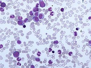 Chronická myelomonocytární leukemie (CMML) - Klonální onemocnění typické perzistující monocytózou s přesahem 10 9 /L - 15-35/milion, starší osoby kolem 70 let