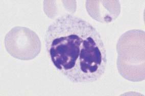 Myeolodysplasie / Myelodysplastický syndrom(mds) pseudo