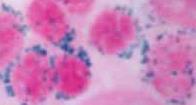 leukocytose - Expozice záření, chemoterapeutikům, benzenu =