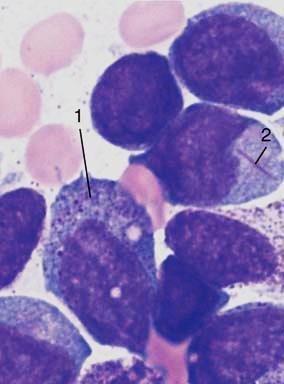 Akutní myeloidní leukémie (AML) - Maligní transformace hematopoetické kmenové buňky na blasty (všech směrů) akumulace klonů
