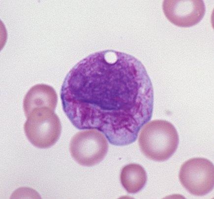 Akutní promyelocytární leukémie (APL) - Častý subtyp AML specifická genetická změna = t(15;17) RARa + PML) zastavení vyzrávání na úrovni promyelocytů - Urgentní stav = riziko rychlého rozvoje