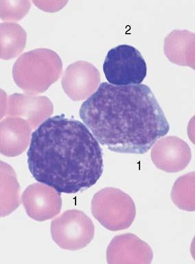 Akutní lymfoblastická leukemie (ALL) - Skupina hematologických neoplasmů vznikajících