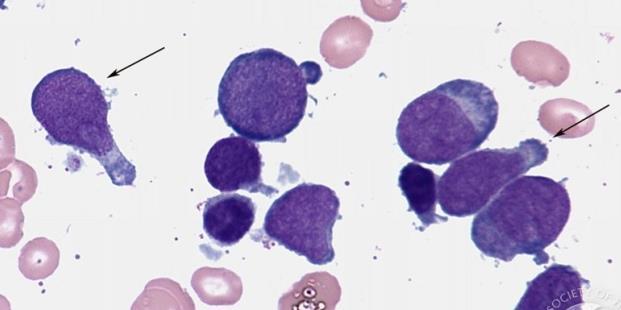 starší 50 let - Klinický obraz: Anemie (bledá kůže), neutropenie (infekce), trombocytopenie