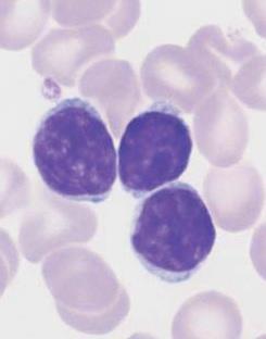 Chronické lymfoproliferativní stavy Chronická lymfocytární leukemie (CLL; chronický lymfoadenom) - leukemie starších lidí, postihuje převážně muže - malé, monoklonální,