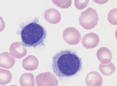 Chronické lymfoproliferativní stavy Vlasato-buněčná leukemie (hairy cell leukemia, HCL) - nezvyklá lymfoproliferativní porucha B-buněk - postihuje převážně muže (5:1) - patogenese neznámá, netečný